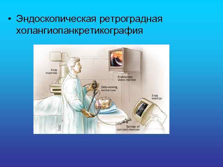  • Эндоскопическая ретроградная холангиопанкретикография 