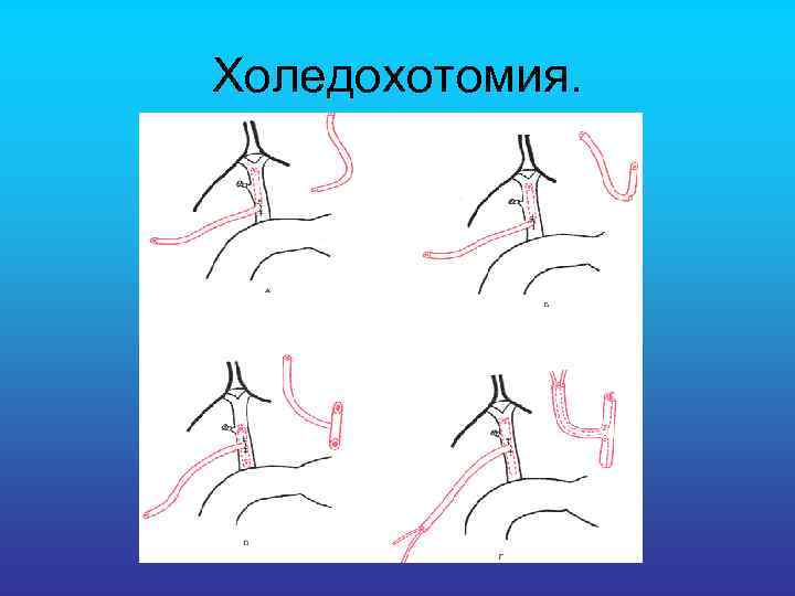 Холедохотомия. 