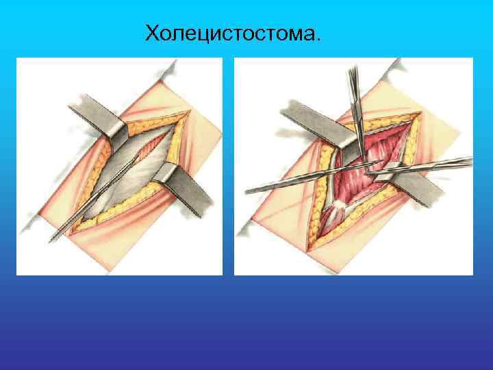  Холецистостома. 