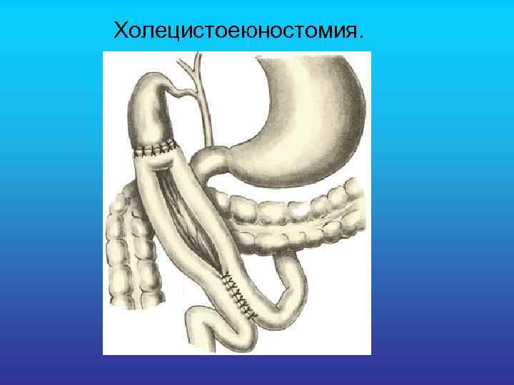  Холецистоеюностомия. 