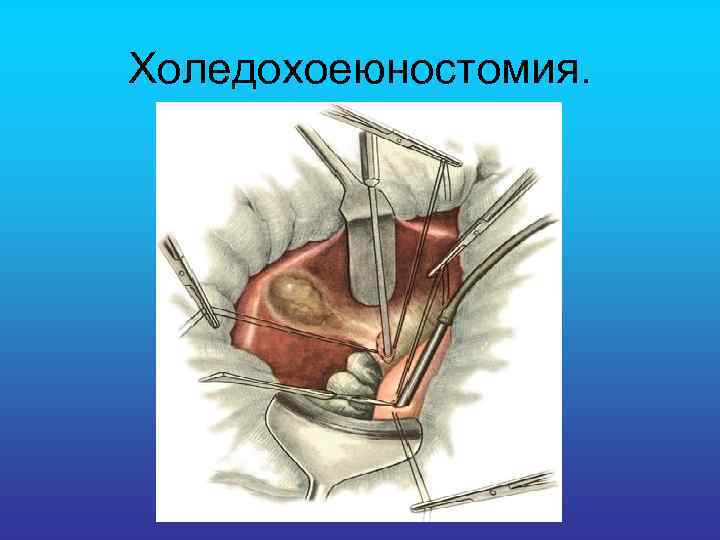 Холедохоеюностомия. 