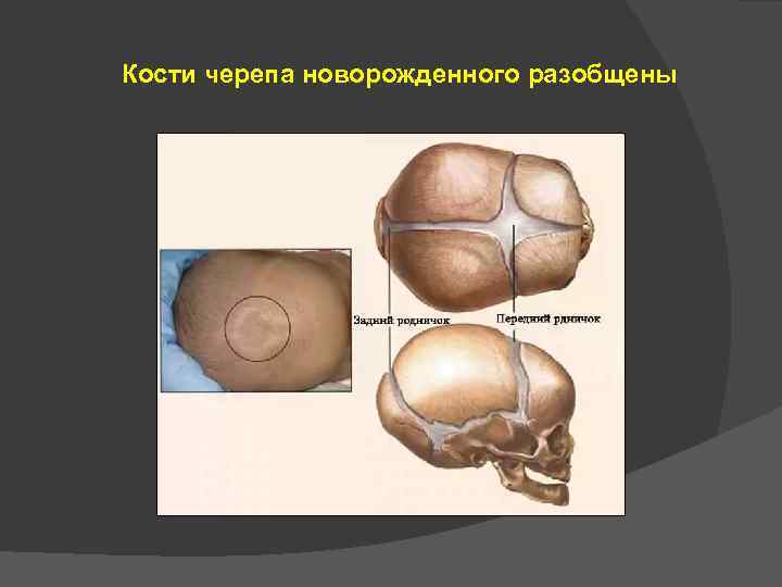 Кости черепа новорожденного разобщены 
