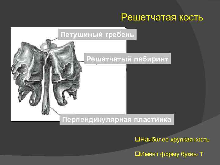 Решетчатая кость Петушиный гребень Решетчатый лабиринт Перпендикулярная пластинка q. Наиболее хрупкая кость q. Имеет