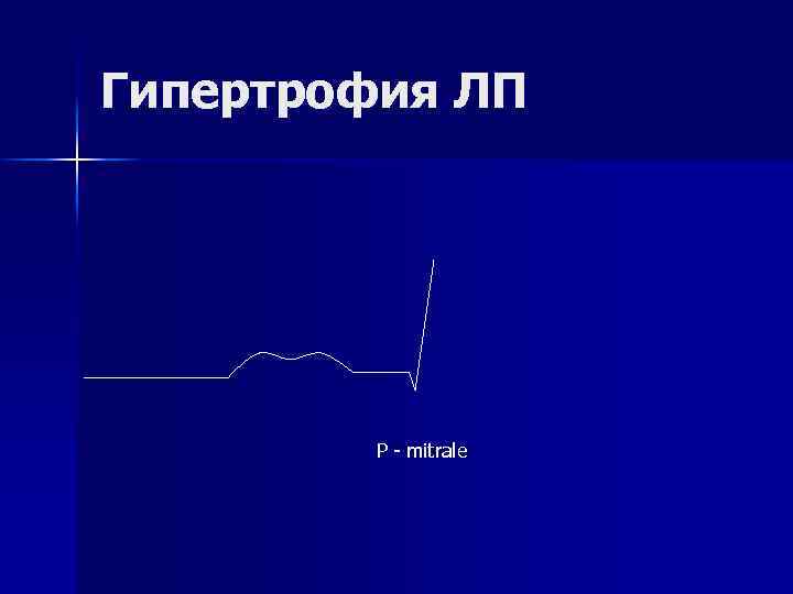 Гипертрофия ЛП Р - mitrale 