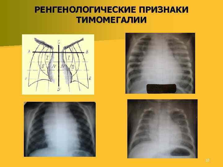 РЕНГЕНОЛОГИЧЕСКИЕ ПРИЗНАКИ ТИМОМЕГАЛИИ 18 