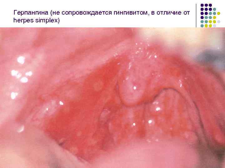 Герпангина (не сопровождается гингивитом, в отличие от herpes simplex) 