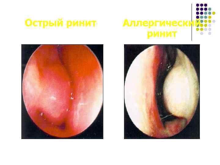 Острый ринит Аллергический ринит 