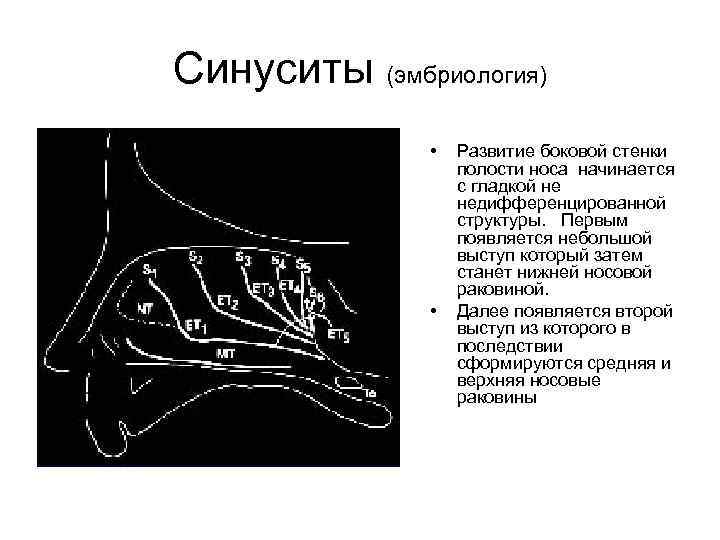 Синуситы (эмбриология) • • Развитие боковой стенки полости носа начинается с гладкой не недифференцированной