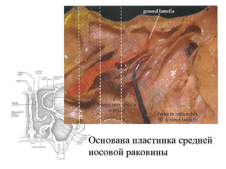 Basal/Ground Lamella Основана пластинка средней носовой раковины 