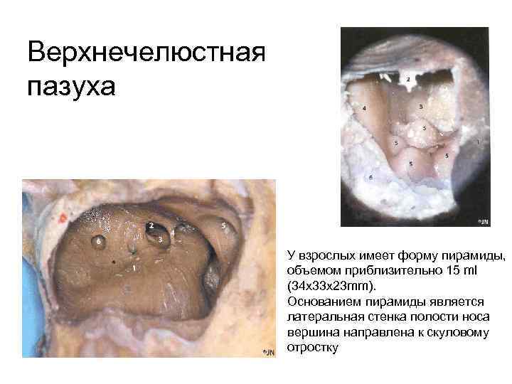 Верхнечелюстная пазуха У взрослых имеет форму пирамиды, объемом приблизительно 15 ml (34 x 33