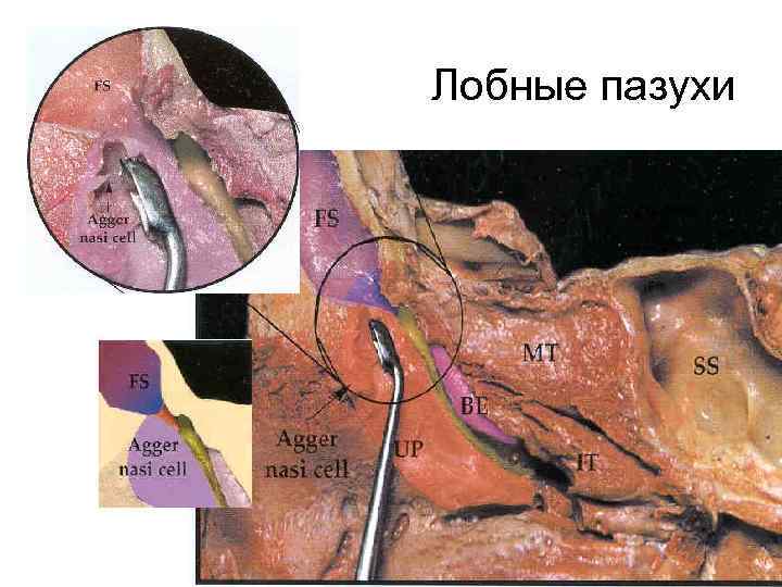 Лобные пазухи 