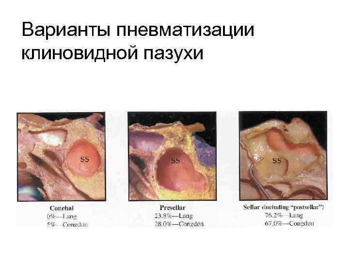 Варианты пневматизации клиновидной пазухи 