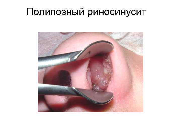 Полипозный риносинусит 