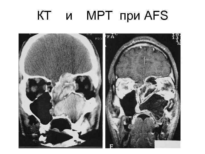 КТ и МРТ при AFS 