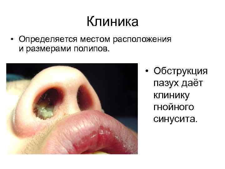 Клиника • Определяется местом расположения и размерами полипов. • Обструкция пазух даёт клинику гнойного