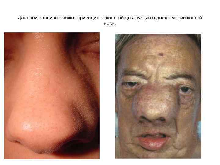 Давление полипов может приводить к костной деструкции и деформации костей носа. 