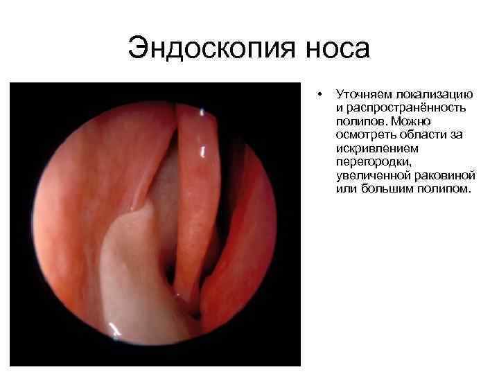 Эндоскопия носа • Уточняем локализацию и распространённость полипов. Можно осмотреть области за искривлением перегородки,