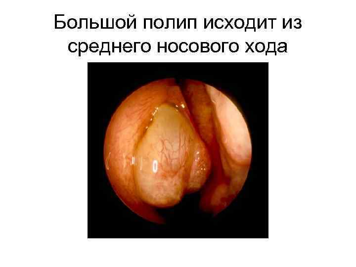 Большой полип исходит из среднего носового хода 