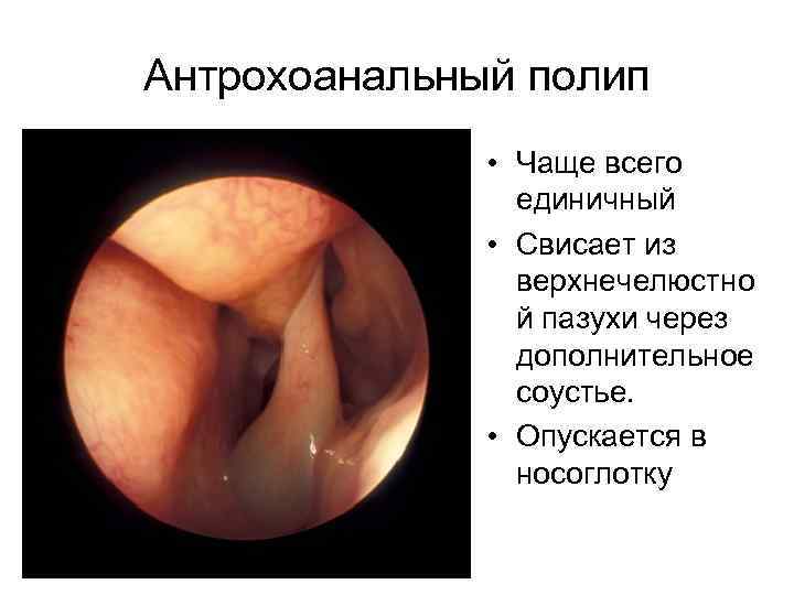 Антрохоанальный полип • Чаще всего единичный • Свисает из верхнечелюстно й пазухи через дополнительное