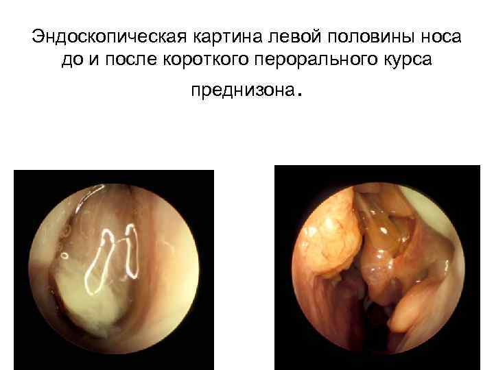 Эндоскопическая картина левой половины носа до и после короткого перорального курса преднизона. 
