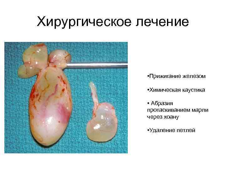Хирургическое лечение • Прижигание железом • Химическая каустика • Абразия протаскиванием марли через хоану