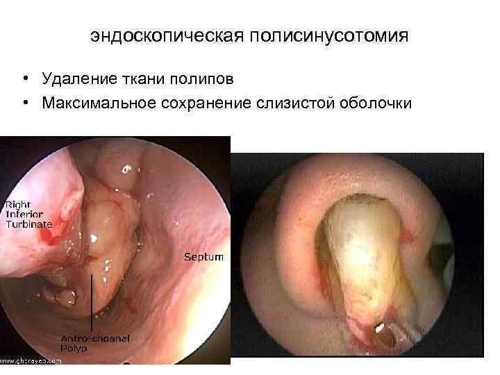 эндоскопическая полисинусотомия • Удаление ткани полипов • Максимальное сохранение слизистой оболочки 