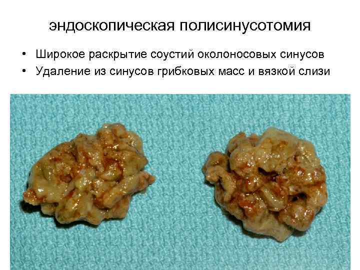 эндоскопическая полисинусотомия • Широкое раскрытие соустий околоносовых синусов • Удаление из синусов грибковых масс