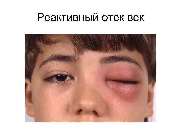 Реактивный отек век 