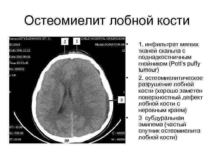 Остеомиелит лобной кости • • • 1. инфильтрат мягких тканей скальпа с поднадкостничным гнойником