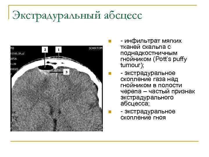 Экстрадуральный абсцесс n n n - инфильтрат мягких тканей скальпа с поднадкостничным гнойником (Pott’s