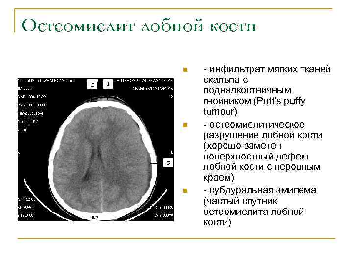 Остеомиелит лобной кости n n n - инфильтрат мягких тканей скальпа с поднадкостничным гнойником