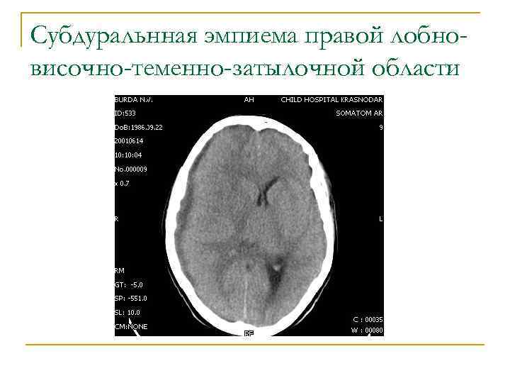Субдуральнная эмпиема правой лобновисочно-теменно-затылочной области 