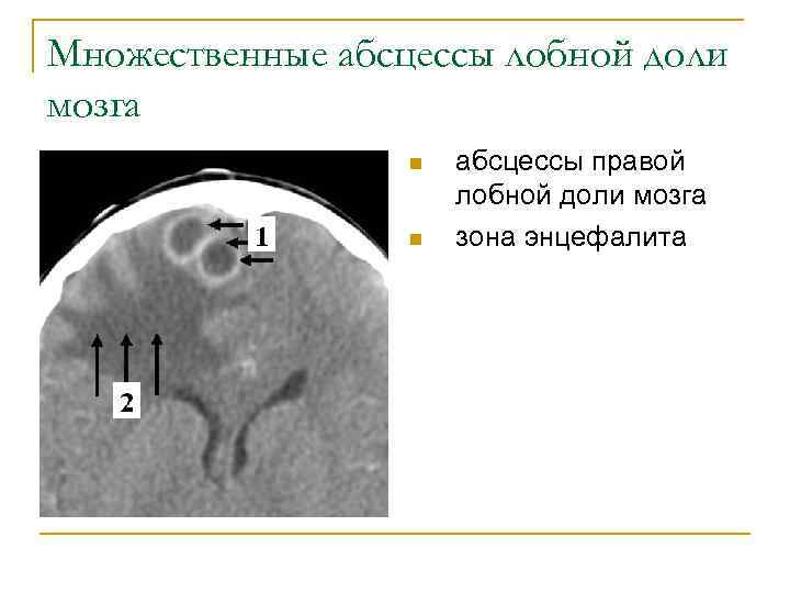 Множественные абсцессы лобной доли мозга n n абсцессы правой лобной доли мозга зона энцефалита