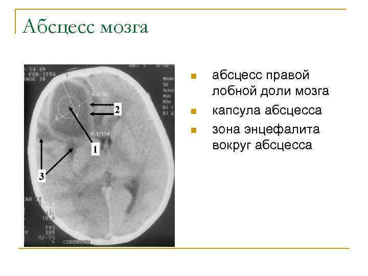 Абсцесс мозга симптомы. Абсцесс головного мозга кт. Экстрадуральный абсцесс кт. Отогенный абсцесс головного мозга.