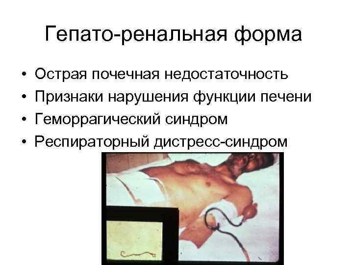 Гепато-ренальная форма • • Острая почечная недостаточность Признаки нарушения функции печени Геморрагический синдром Респираторный