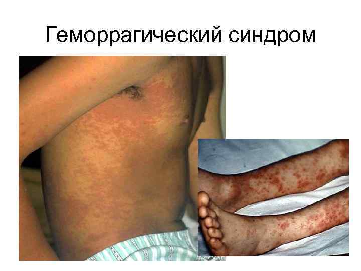 Геморрагический синдром 