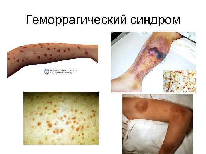 Геморрагический синдром 