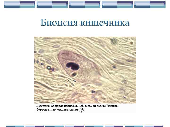 Биопсия кишечника 