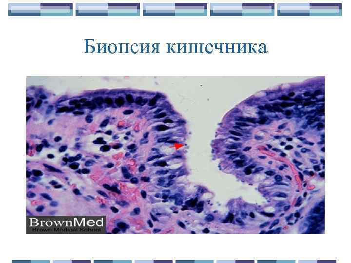 Биопсия кишечника 