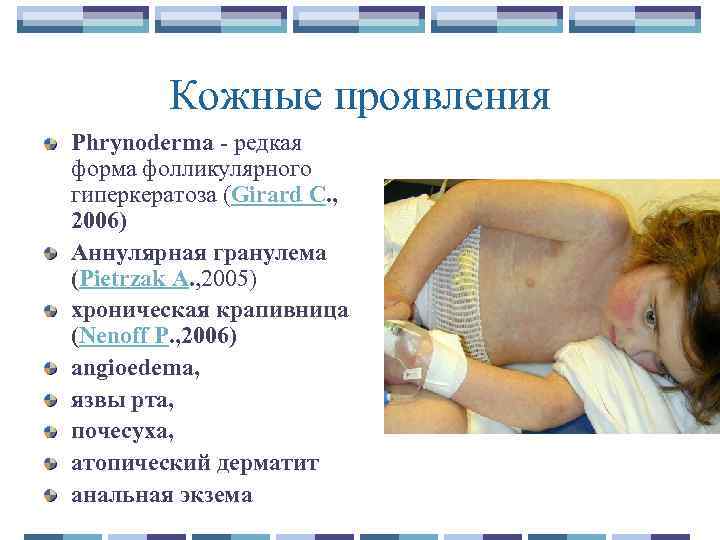 Кожные проявления Phrynoderma - редкая форма фолликулярного гиперкератоза (Girard C. , 2006) Аннулярная гранулема