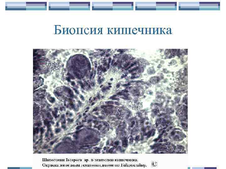Биопсия кишечника 