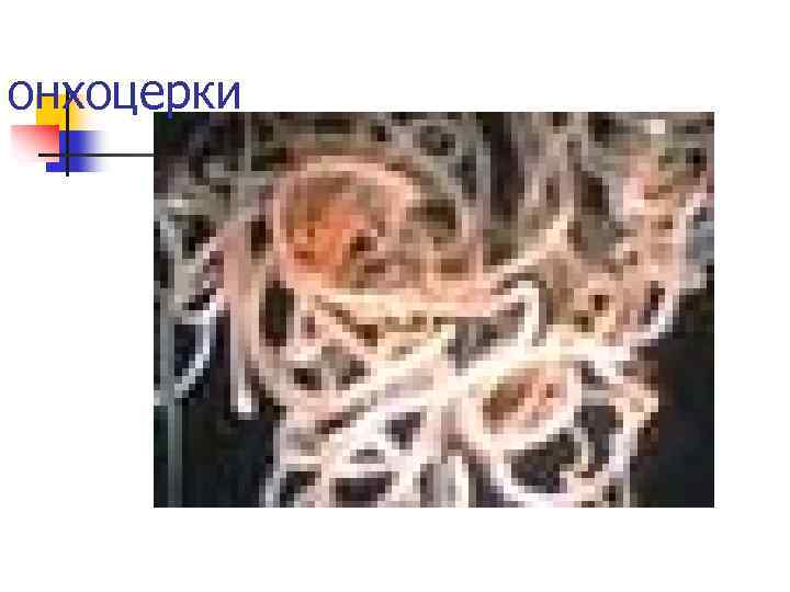онхоцерки 