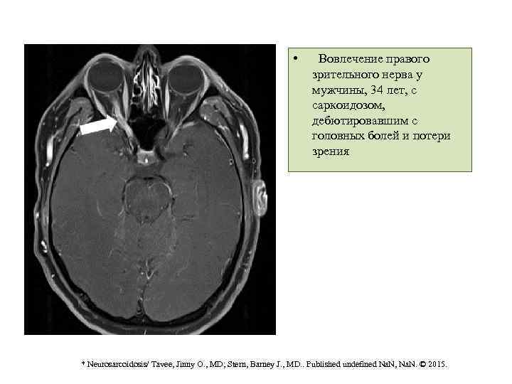  • Вовлечение правого зрительного нерва у мужчины, 34 лет, с саркоидозом, дебютировавшим с