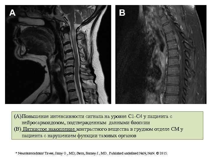 (A) Повышение интенсивности сигнала на уровне С 1 -С 4 у пациента с нейросаркоидозом,