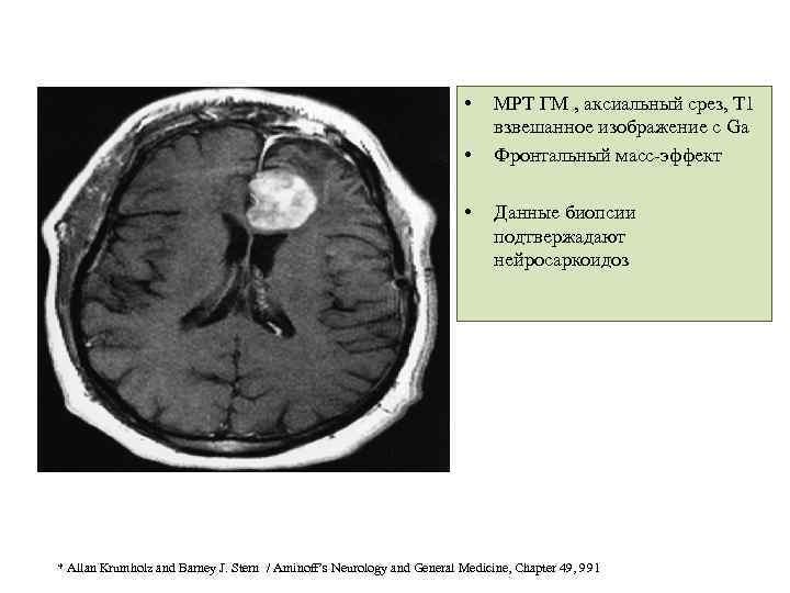 • • • МРТ ГМ , аксиальный срез, Т 1 взвешанное изображение с
