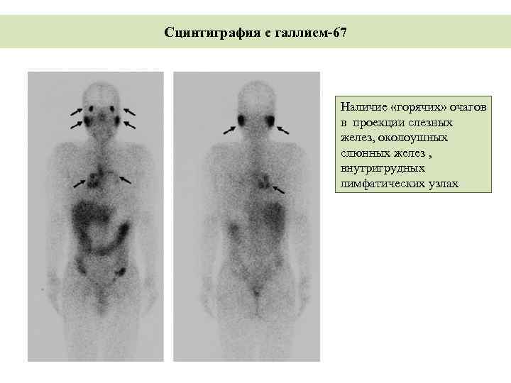 Сцинтиграфия с галлием-67 Наличие «горячих» очагов в проекции слезных желез, околоушных слюнных желез ,