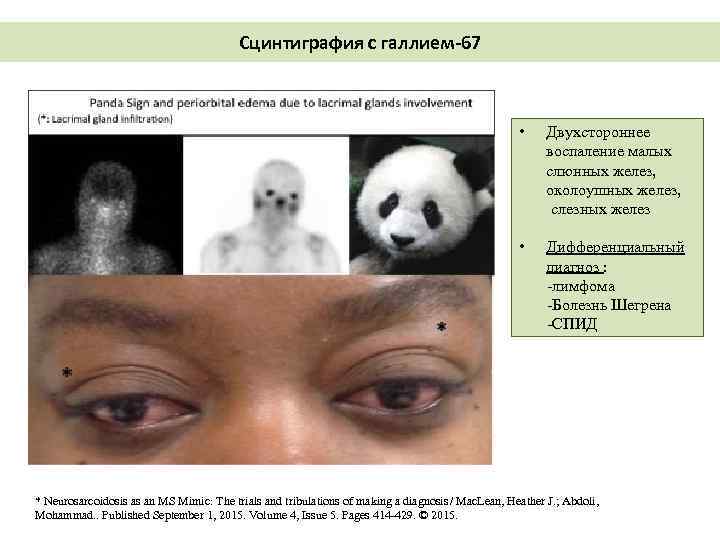 Сцинтиграфия с галлием-67 • Двухстороннее воспаление малых слюнных желез, околоушных желез, слезных желез •
