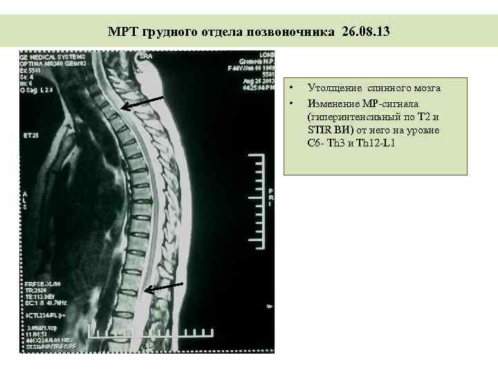 Мр картина дистрофических изменений поясничного отдела позвоночника. Мрт спинного мозга грудной отдел. Т1 и т2 отделы позвоночника. Мрт грудного отдела позвонка.