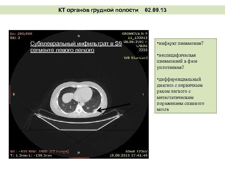 КТ органов грудной полости Субплевральный инфильтрат в S 9 сегменте левого легкого 02. 09.