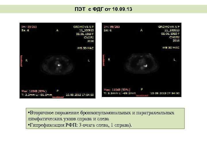 ПЭТ с ФДГ от 10. 09. 13 • Вторичное поражение бронхопульмональных и паратрахеальных лимфатических